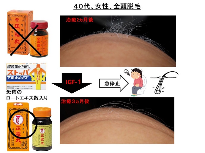 円形脱毛症　病院